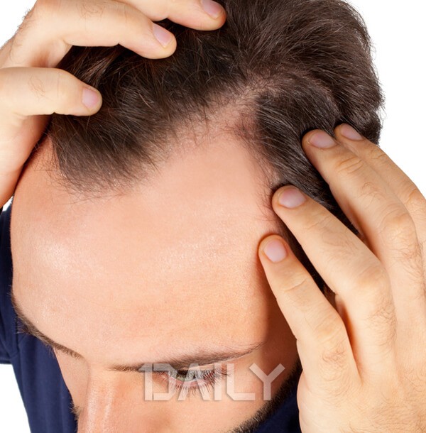 나도 M자탈모? 탈모가 의심되는 증상