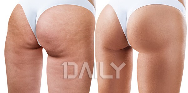 울퉁불퉁 셀룰라이트에 대한 진실과 거