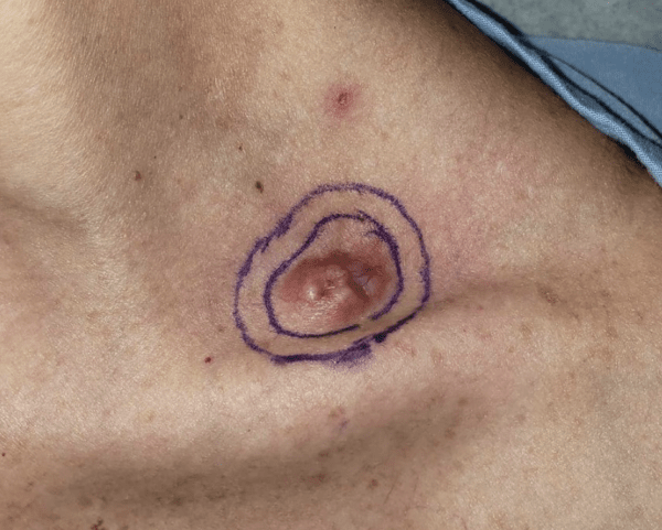 skincancer